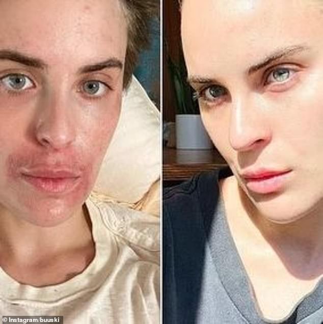 30-летняя дочь Брюса Уиллиса и Деми Мур зашла в свой Instagram, чтобы поделиться невероятными фотографиями до и после того, как ее лицо «исцелилось» от болезни.