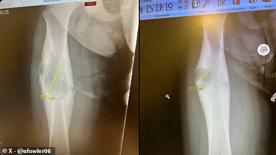 Он поделился изображением, на котором якобы видно, что опухоль его дочери уменьшилась в два раза - после того, как регулярно рекламировал компанию Supreme CBD, которую он основал.